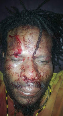 20-year-old student Obi Kogoya attacked by Indonesian police and militia on 15th July outside the boarding house Yogyakarta