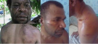 Obed Pahabol (kiri) dan Yosafat Bahabol (Kanan), menunjukkan luka akibat penyiksaan yang diduga dilakukan oleh polisi (Dok.AHRC)